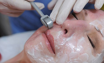 Dermaroller Treatments